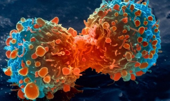 A close up image of cancer cells that can be treated with the non-psychotropic elements of cannabis.