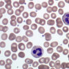 Acute Lymphoblastic Leukemia cells