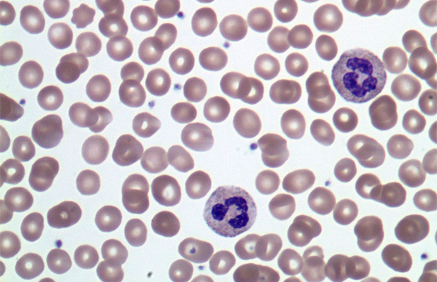 Acute Lymphoblastic Leukemia cells