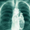 An x-ray shows a healthy heart within a rib cage, even though the owner has smoked marijuana.