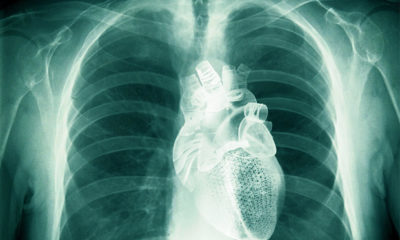 An x-ray shows a healthy heart within a rib cage, even though the owner has smoked marijuana.